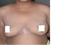 Breast Reduction in Kolkata 