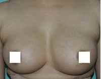Breast Augmentation in Kolkata