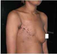 breast reconstruction surgery 