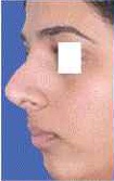 Rhinoplasty Surgery in Kolkata 