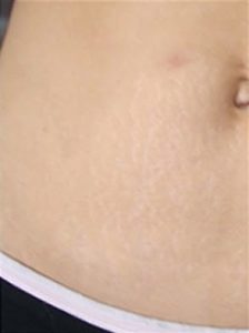 Stretch Marks Treatment in Kolkata