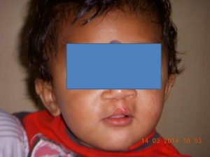 Cleft lip palate in Kolkata