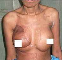 breast reconstruction surgery in kolkata