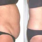 Body Contouring Surgeon in Kolkata