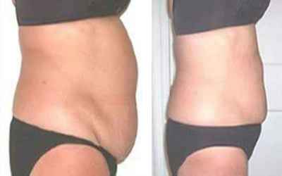 Body Contouring Surgeon in Kolkata