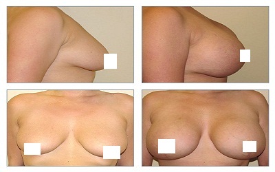 Breast Surgery in Kolkata