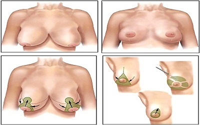 Breast Surgery