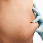 Tummy Tuck Surgeon in Kolkata