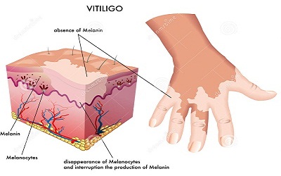 Skin Defects 