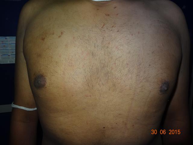 Gynecomastia surgery in Kolkata