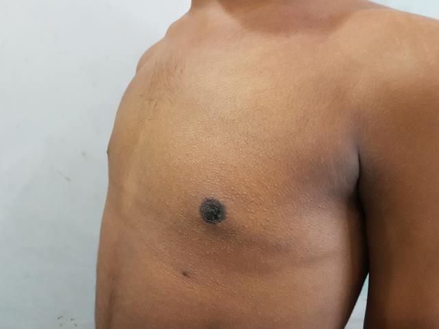 Gynecomastia surgery in Kolkata After