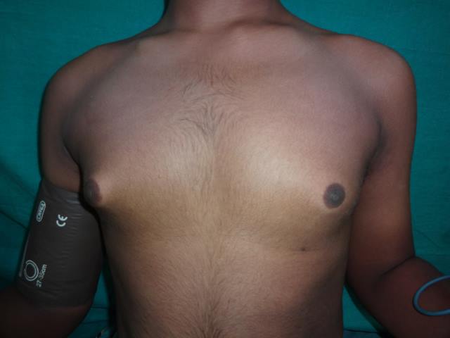 Gynecomastia