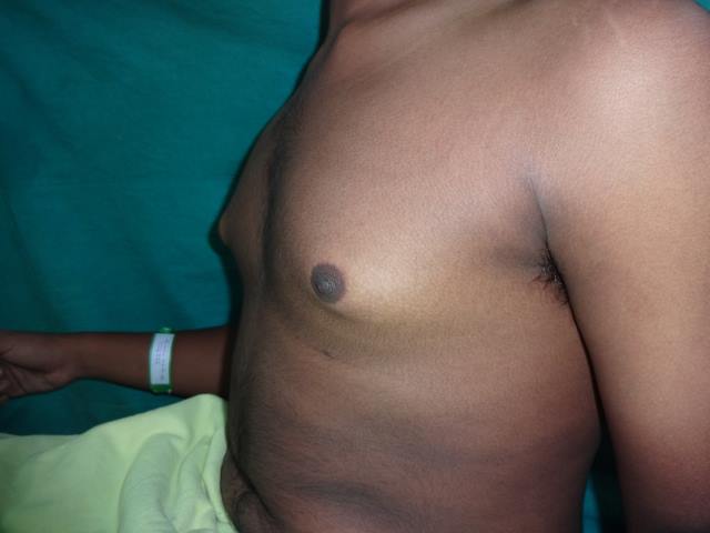 Gynecomastia surgery before