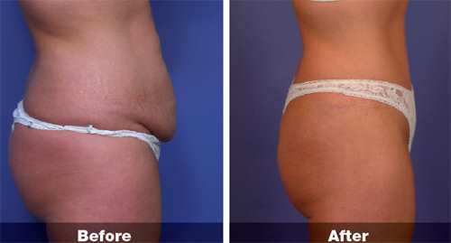 Abdominoplasty Surgery in Kolkata