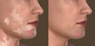 Vitiligo Treatment in Kolkata
