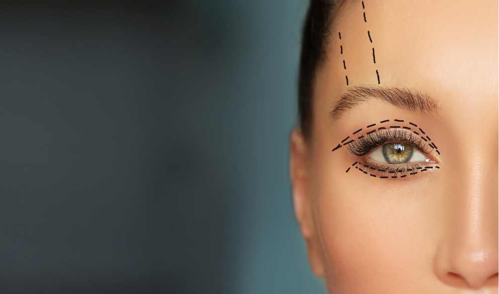 Eyelid Surgeon in Kolkata