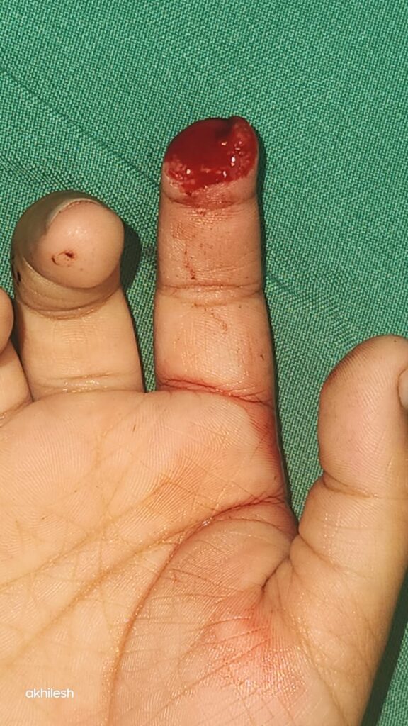Finger Reimplantation