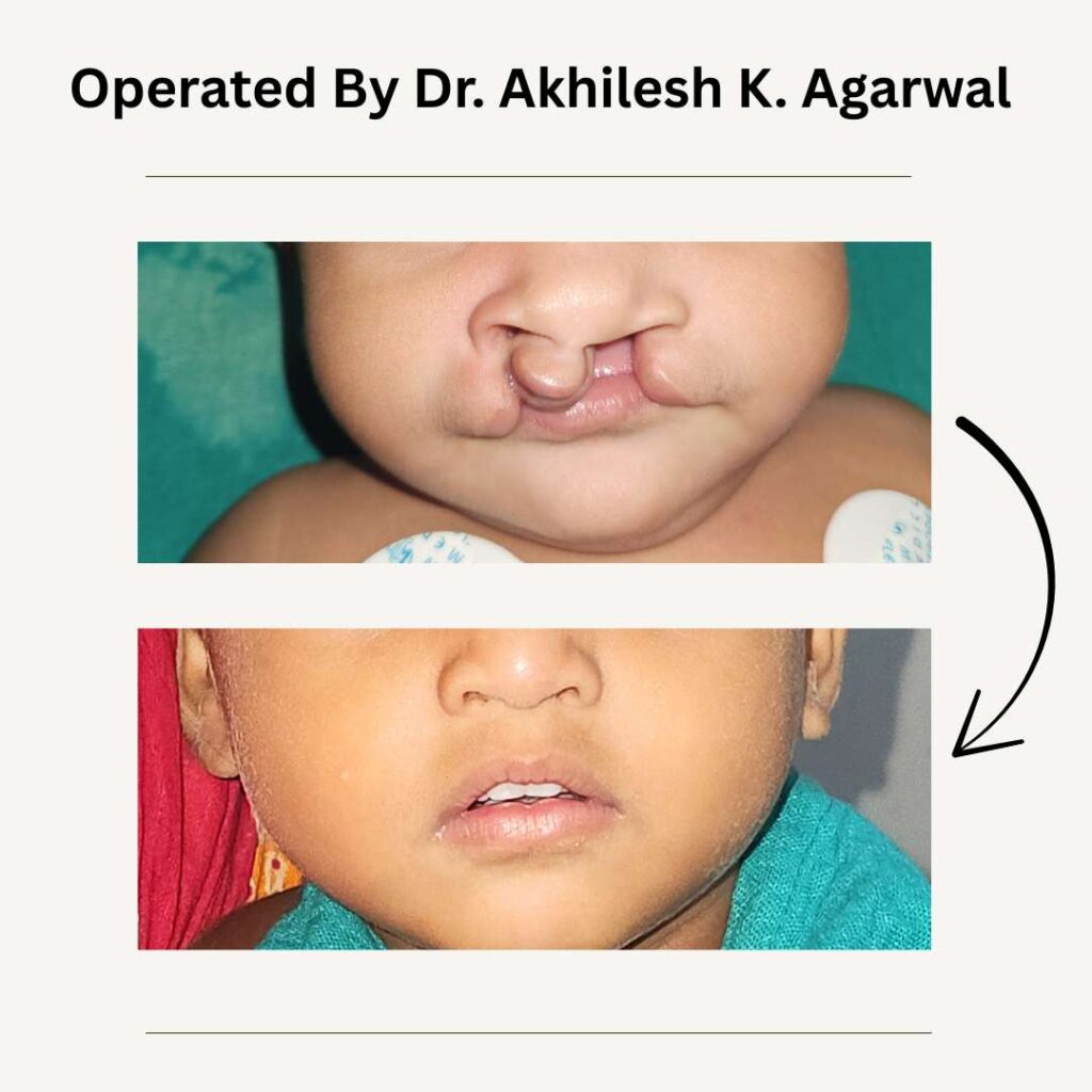 Cleft lip Palate Surgery