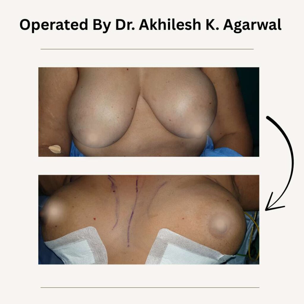 breast