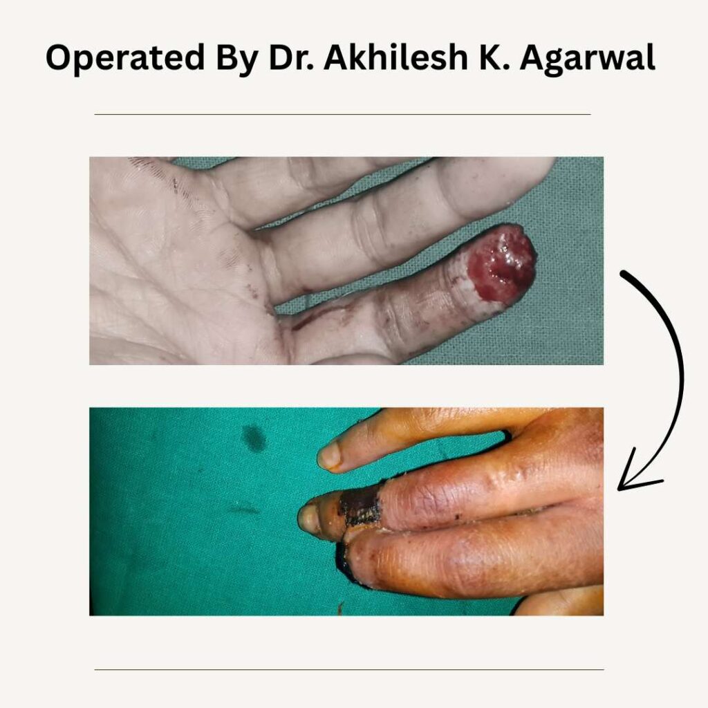 finger cut surgery