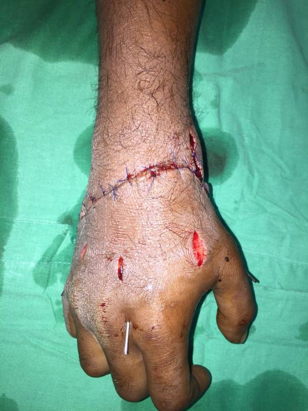 Hand Surgery in Bangladesh 
