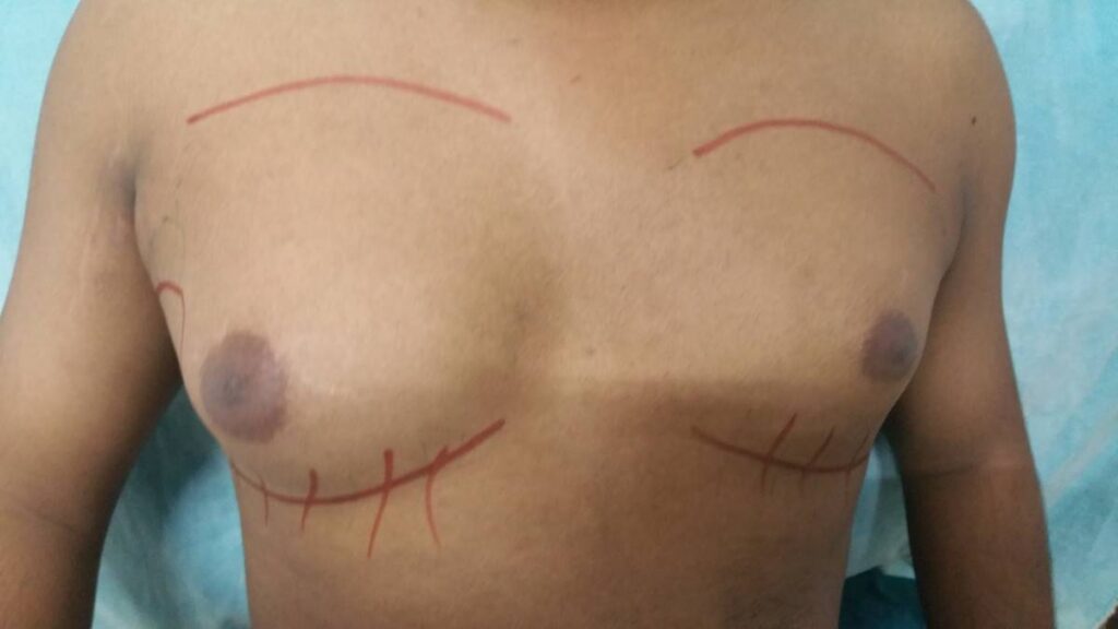 Plastic Surgery Dhaka & Chattogram