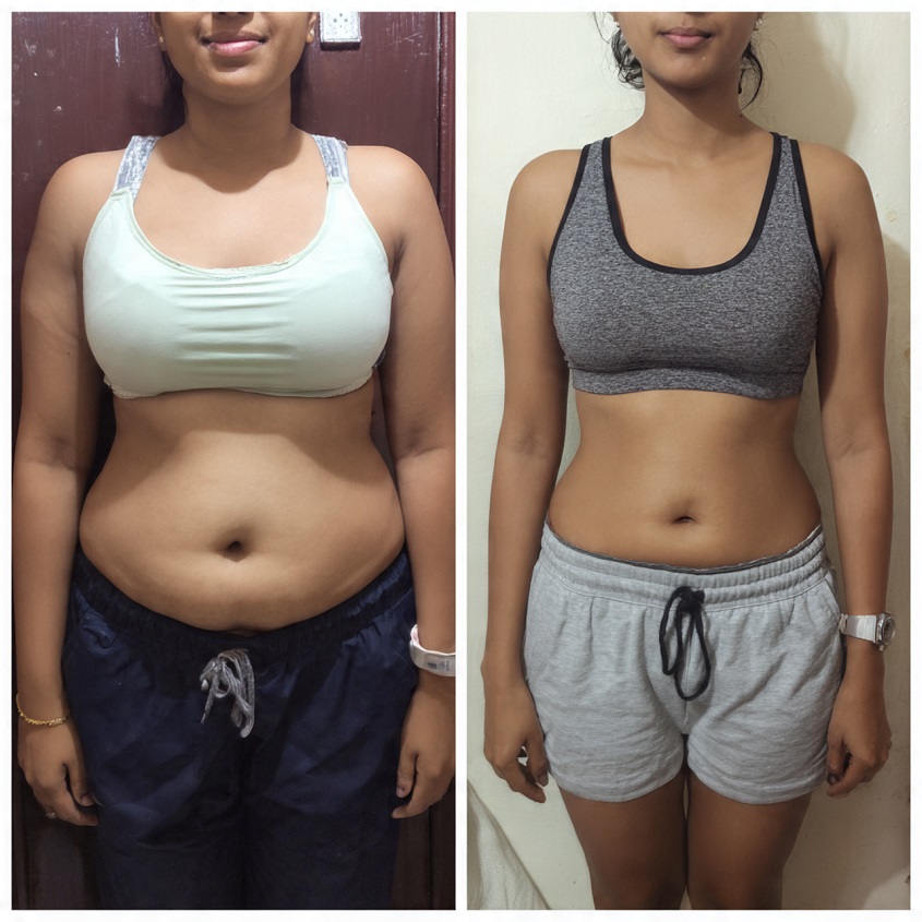 Fat Loss Surgery in Kolkata